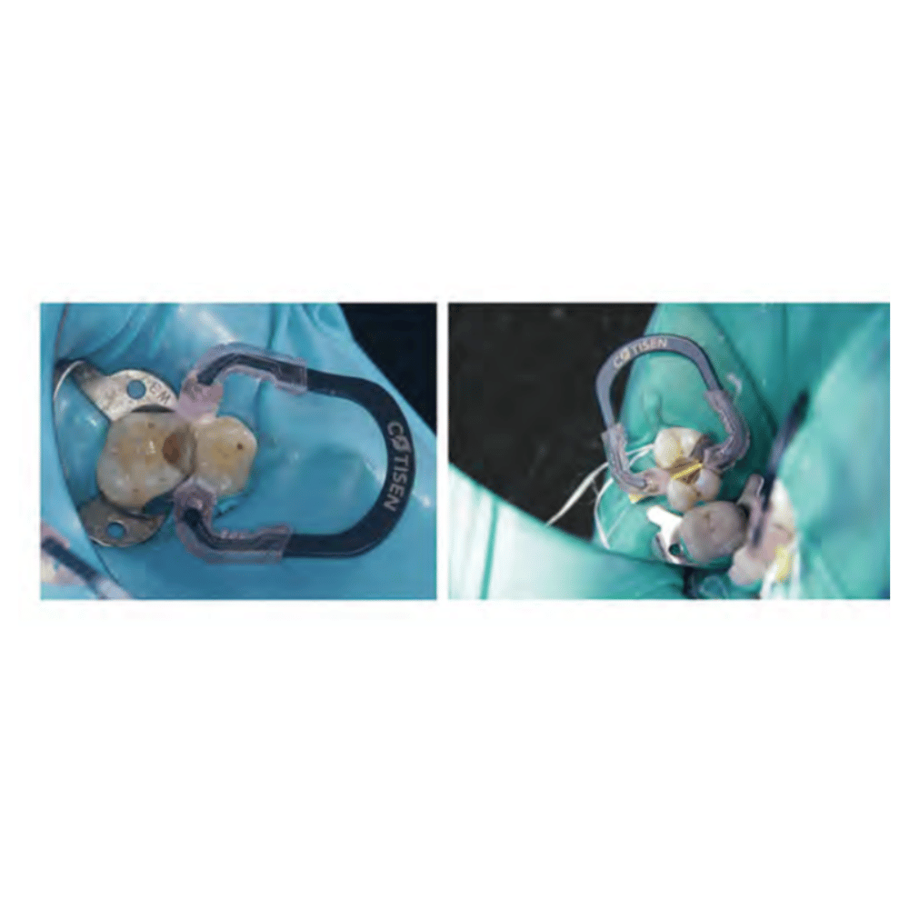 Matrizen Clip Klammerring PS-SC020_4