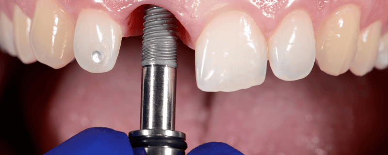 Fortschritt in der Zahnmedizin: Moderne Chirurgie- und Implantologiegeräte im Praxisalltag