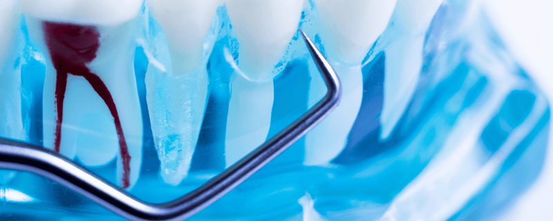 Ultraschallspitzen in der Endodontie