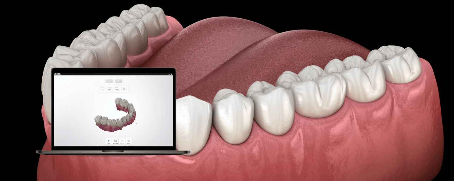 Von analog auf digital mit dem Intraoral Scanner