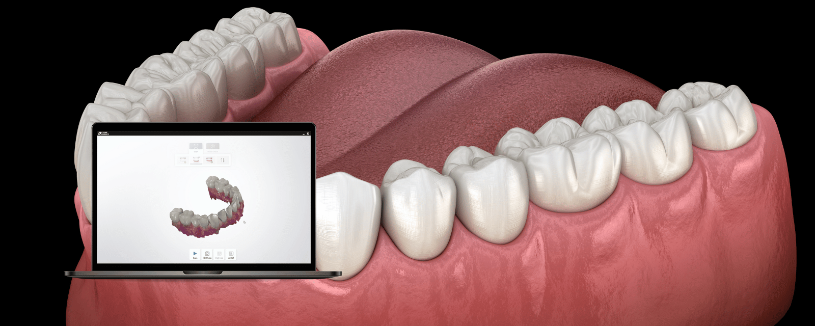Von analog auf digital mit dem Intraoral Scanner