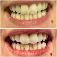 MANIShine Whitening Office Set - Bleachingmaterial mit 35% Wasserstoffperoxid