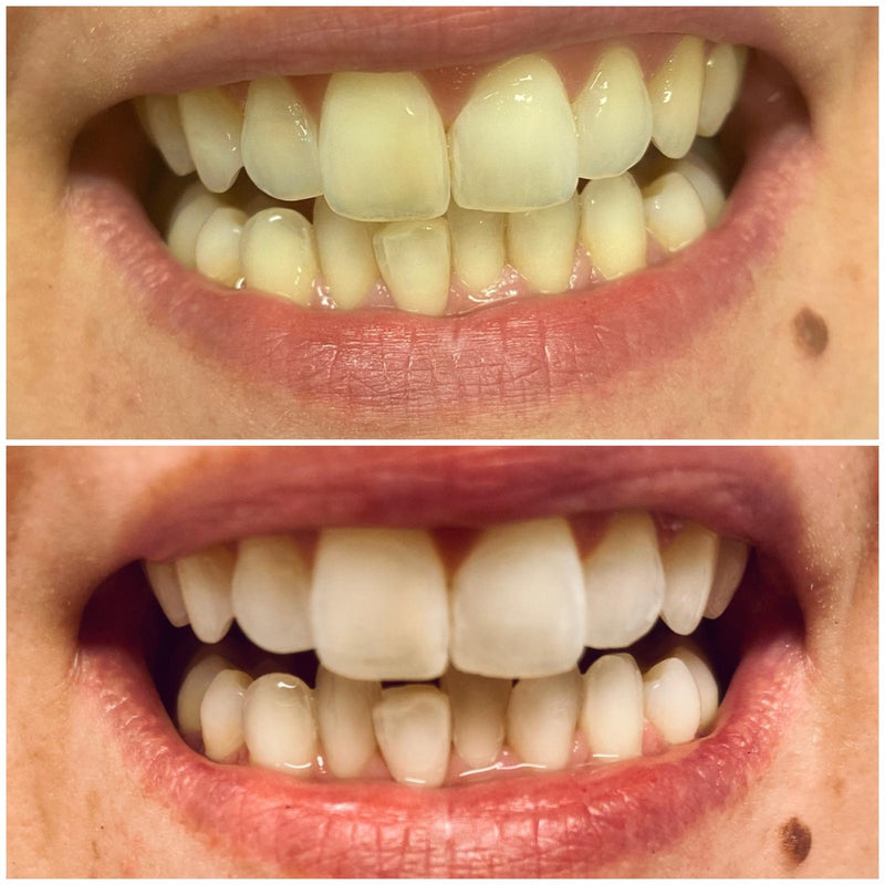 MANIShine Whitening Office Set - Bleachingmaterial mit 35% Wasserstoffperoxid