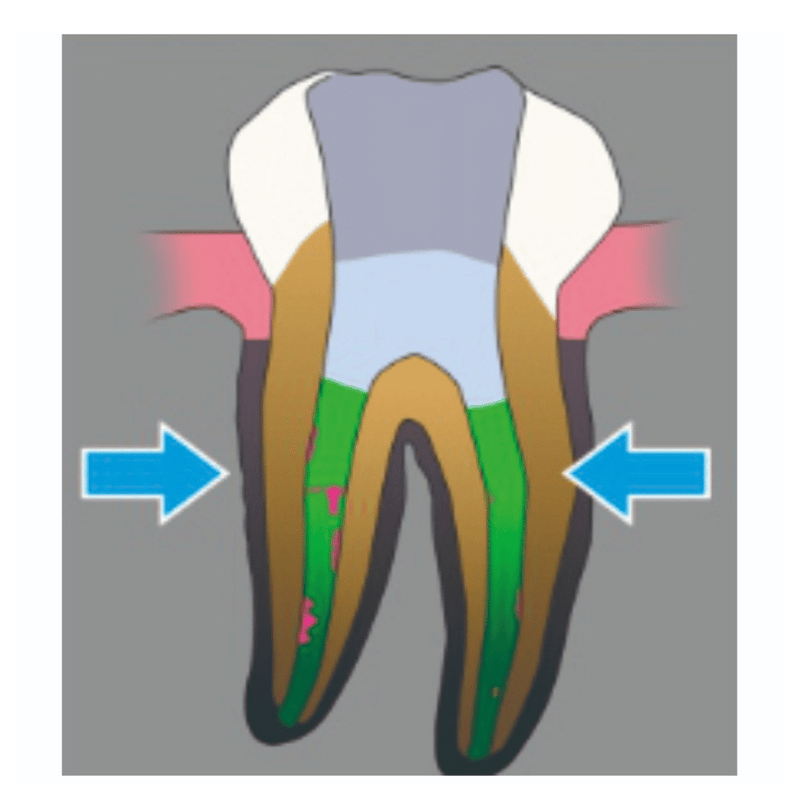 SC-PRO NiTi Endo Feile Wurzelkanalinstrument_4