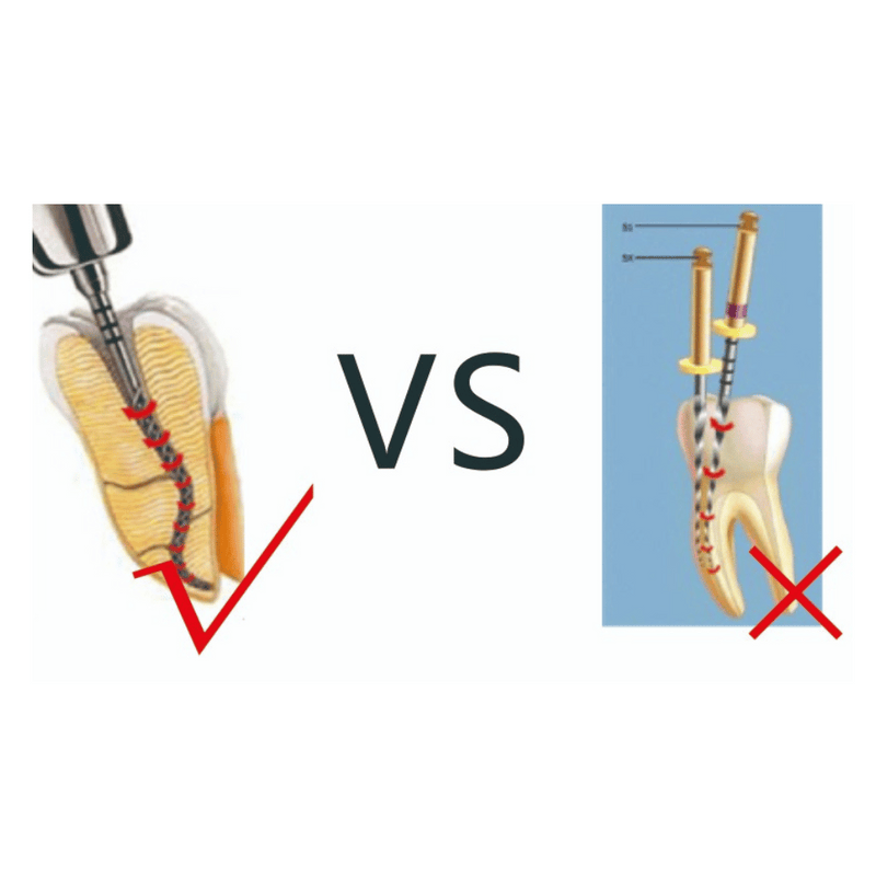 SC-PRO NiTi Endo Feile Wurzelkanalinstrument_6