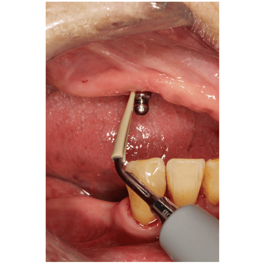 Scorpion Safe Implant Cleaner Clip Implantreinigung Ultraschallspitze SC-Clip_6