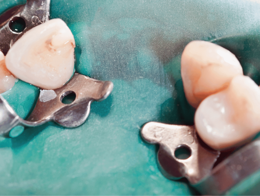 Zahnarztpraxis Kofferdam Dental Klammer Zange Endodontie mobile