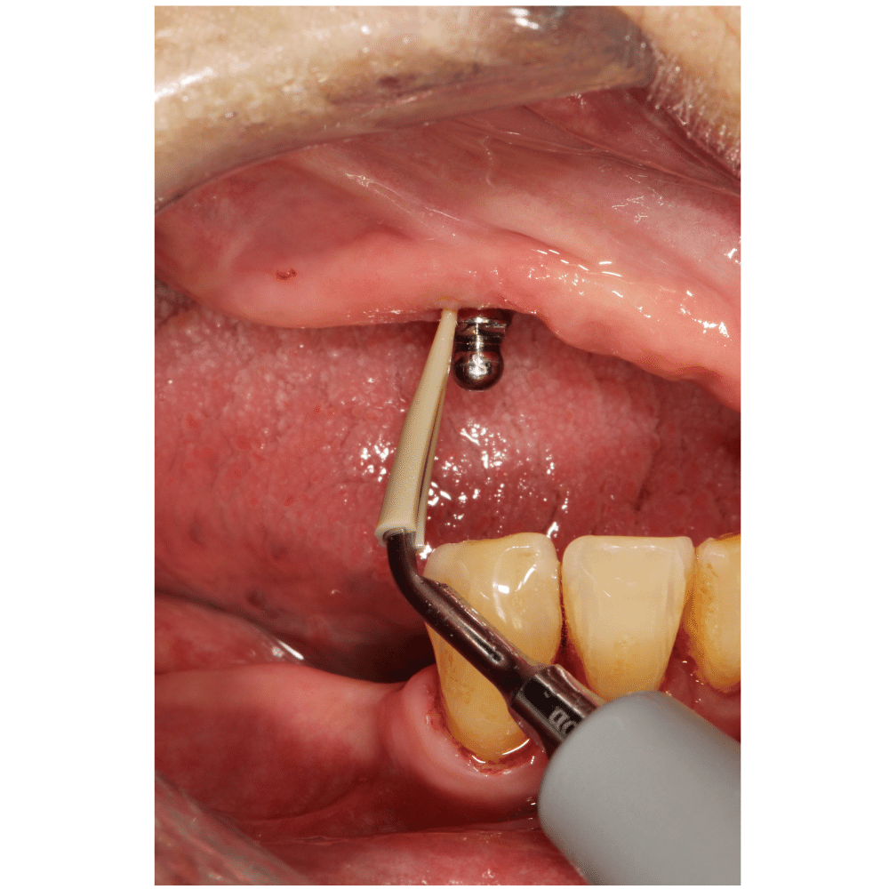 Scorpion Safe Implant Cleaner Clip Implantatreinigung Ultraschallspitze_SC-CLip_5